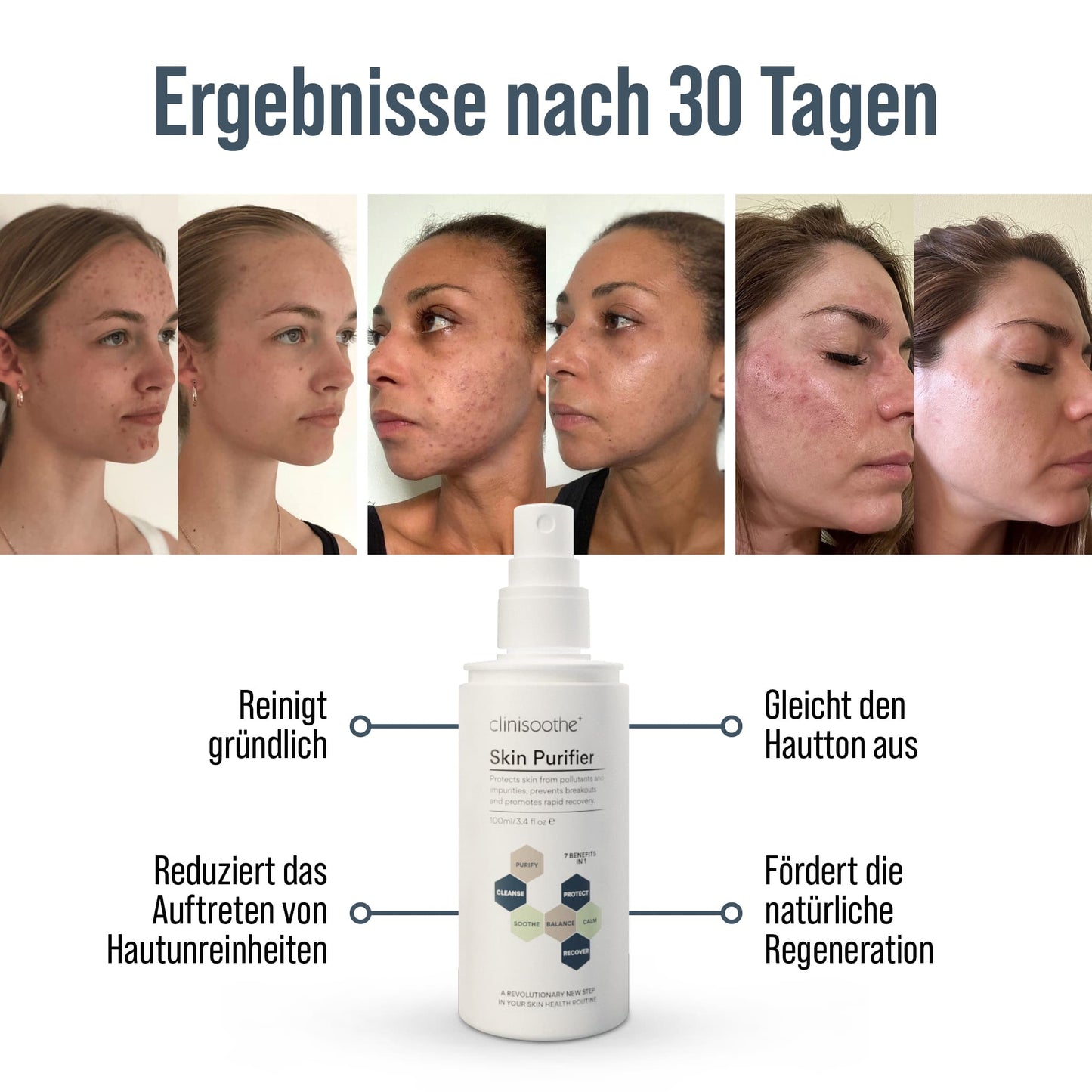 Infografik mit Vorher-Nachher-Bildern von drei Frauen, die Ergebnisse nach 30 Tagen Anwendung von Clinisoothe Skin Purifier zeigen. In der Mitte eine Flasche des Produkts, daneben die Vorteile: reinigt gründlich, reduziert Hautunreinheiten, gleicht den Hautton aus, fördert die natürliche Regeneration.