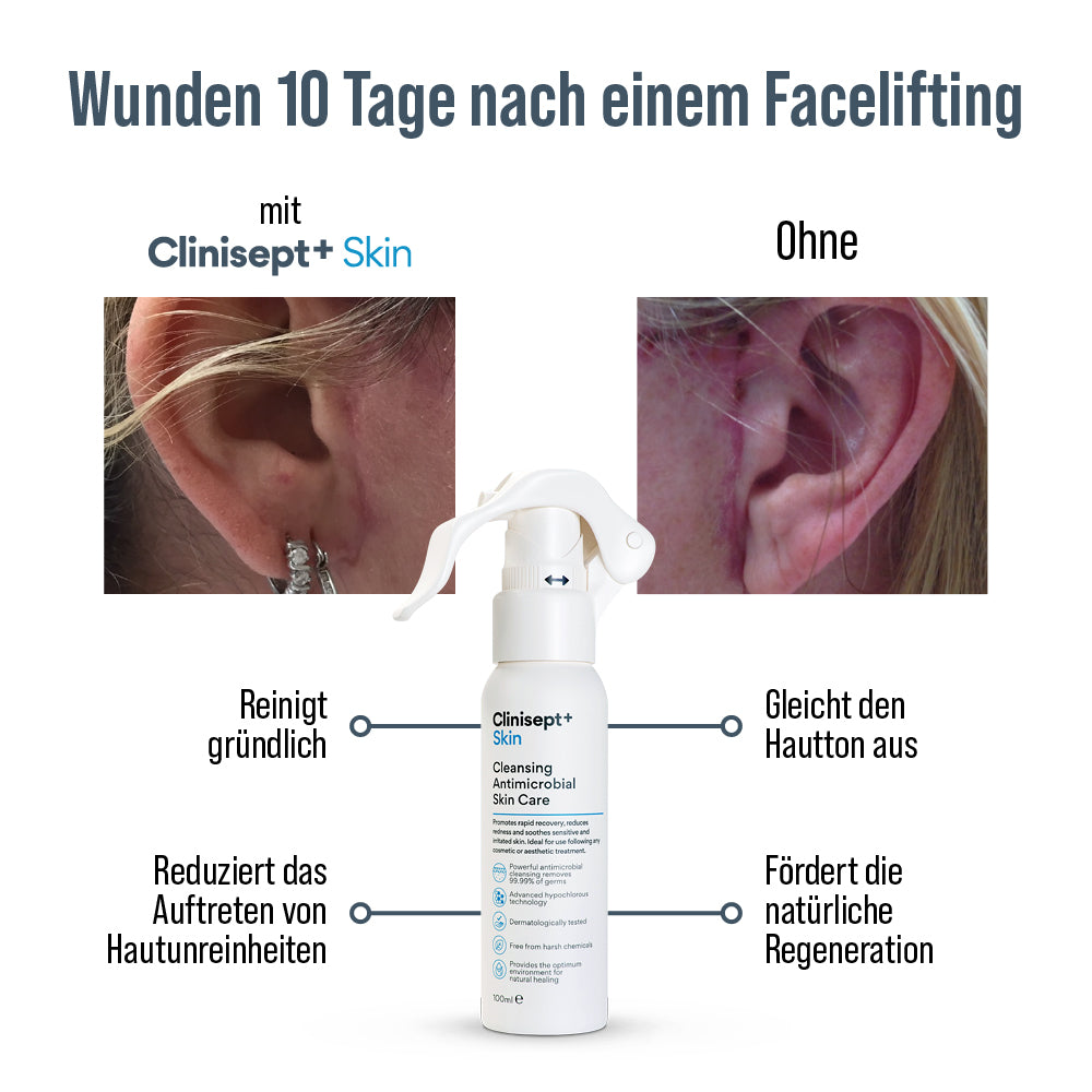 Infografik: Wunden 10 Tage nach Facelifting – links mit Clinisept+ Skin sichtbar gepflegt, rechts ohne Produkt stärker gerötet; Vorteile der 100 ml Sprühflasche wie gründliche Reinigung, weniger Hautunreinheiten, ausgeglichener Hautton und Förderung der Regeneration