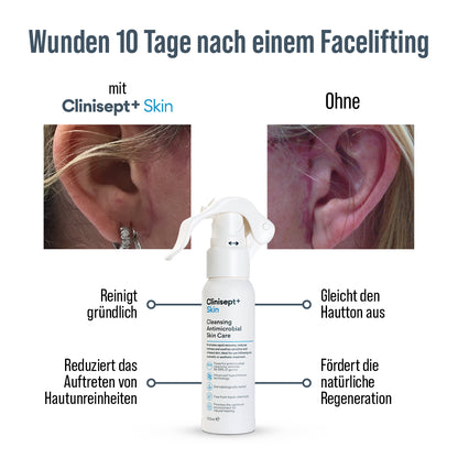 Infografik: Wunden 10 Tage nach Facelifting – links mit Clinisept+ Skin sichtbar gepflegt, rechts ohne Produkt stärker gerötet; Vorteile der 100 ml Sprühflasche wie gründliche Reinigung, weniger Hautunreinheiten, ausgeglichener Hautton und Förderung der Regeneration