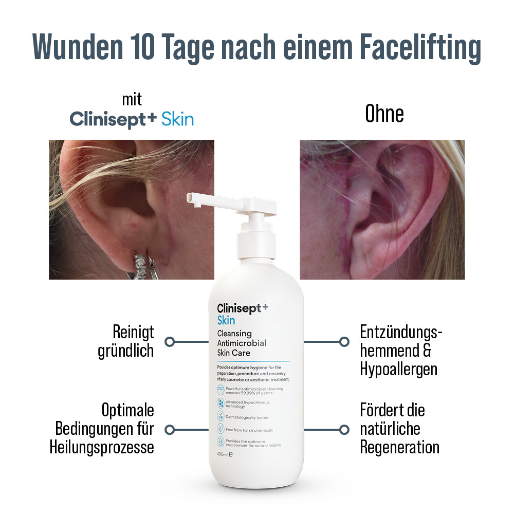 Infografik: Wunden 10 Tage nach Facelifting – links mit Clinisept+ Skin sichtbar beruhigt und gepflegt, rechts ohne Produkt stärker gerötet; Vorteile wie gründliche Reinigung, optimale Heilungsbedingungen und entzündungshemmende Wirkung hervorgehoben