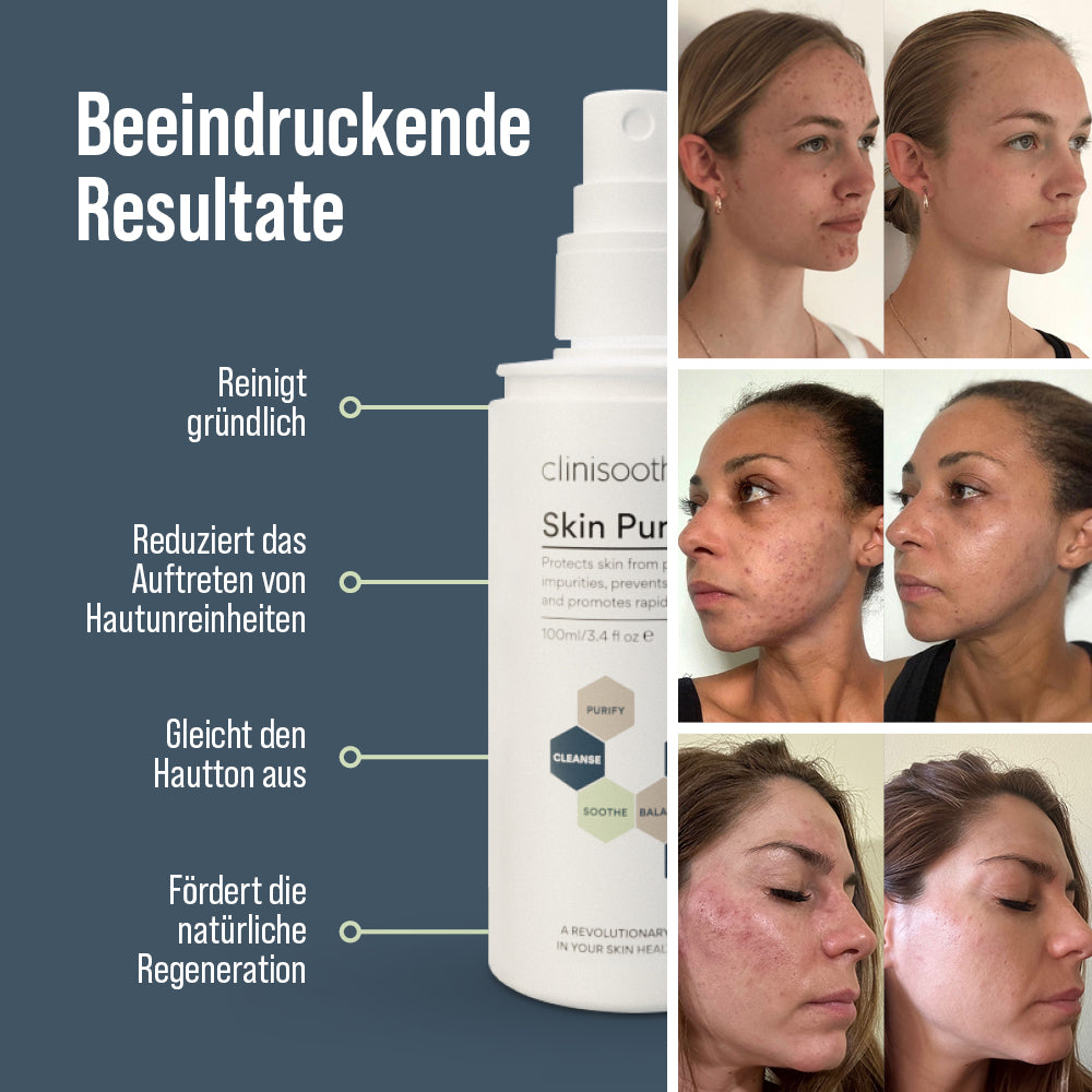 Clinisoothe+ Skin Purifier 100 ml Sprayflasche mit Text „Beeindruckende Resultate“; links vier Produktvorteile (reinigt gründlich, reduziert Hautunreinheiten, gleicht Hautton aus, fördert Regeneration), rechts Vorher-nachher-Fotos von drei Frauen mit sichtbarer Hautverbesserung.